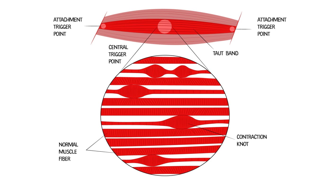 What are trigger points? | ToThePoint Massage Adelaide